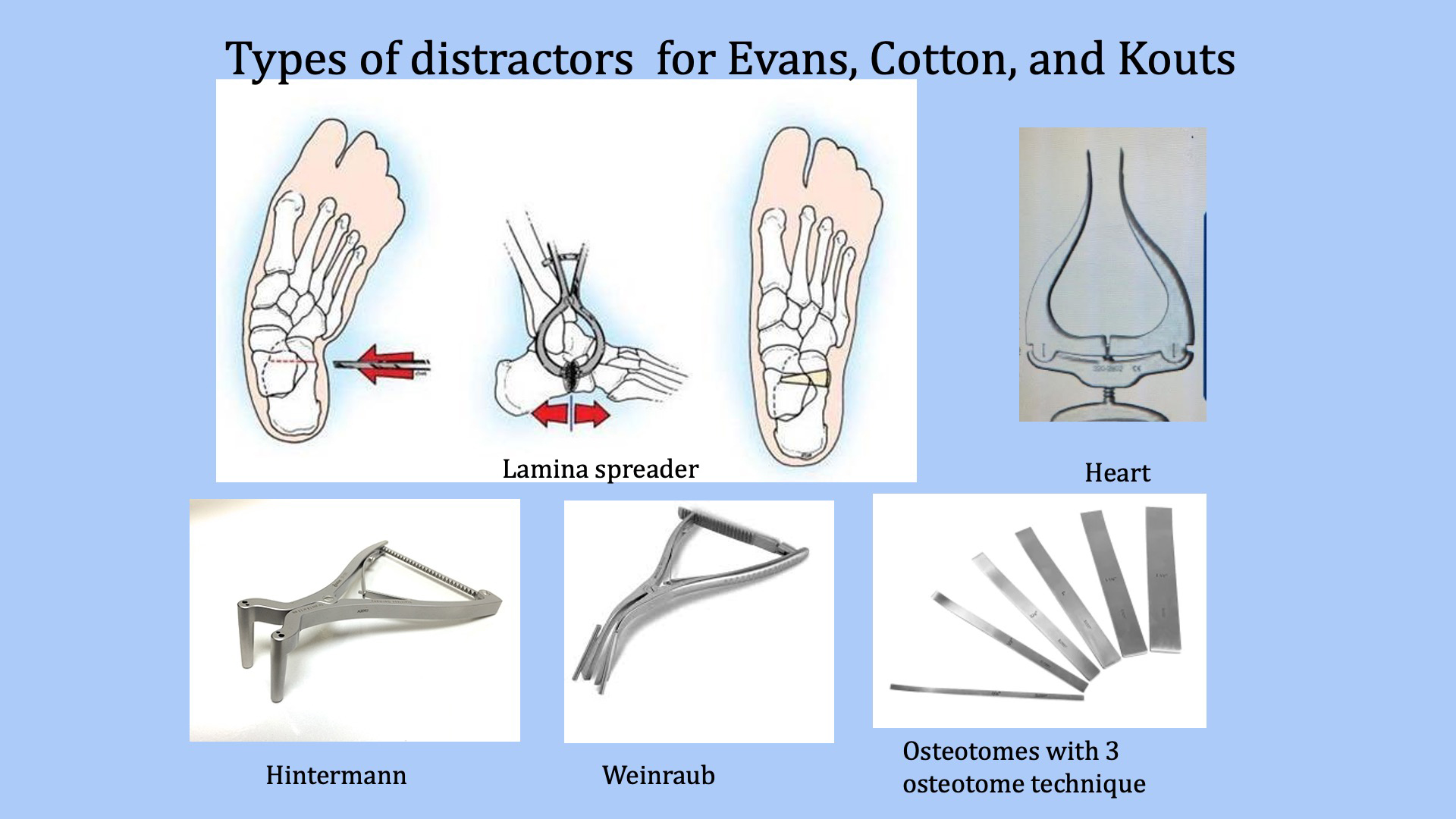 This Just In... Calcaneal and Cotton Osteotomies for Flatfoot Correction